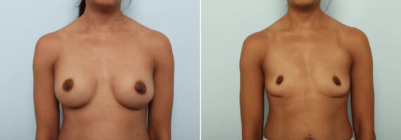 Breast Implant Removal before and after photos in Houston, TX, Patient 85691