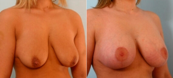 Breast Lift with Augmentation before and after photos in Houston, TX, Patient 27368