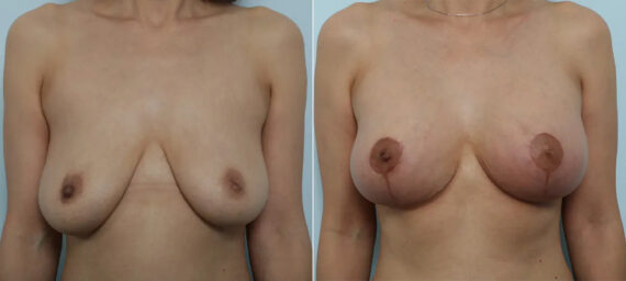 Breast Lift with Augmentation before and after photos in Houston, TX, Patient 70608