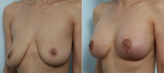 Breast Lift with Augmentation before and after photos in Houston, TX, Patient 70608