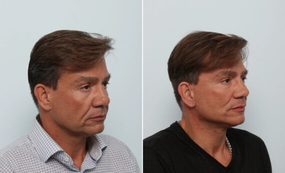 Facelift before and after photos in Houston, TX, Patient 85474