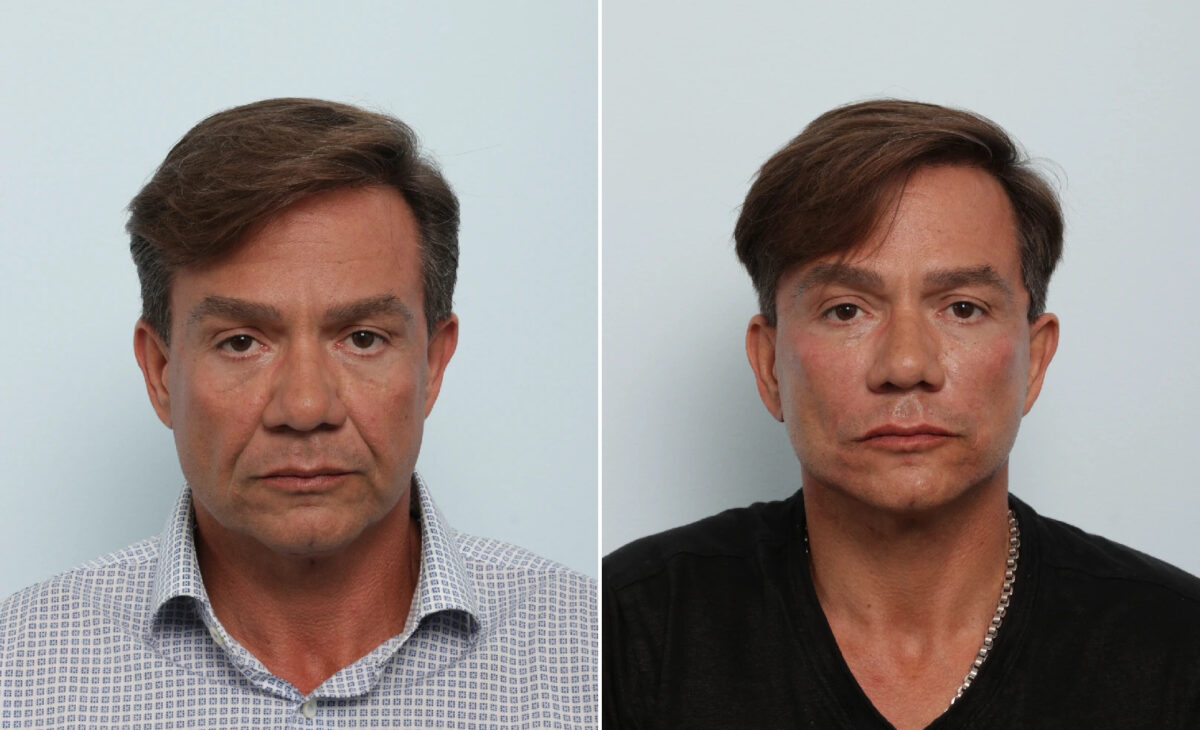 Facelift Before and After Photos in Houston, TX, Patient 85474