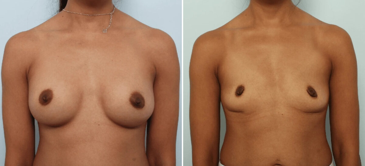 Patient 85691, Breast Implant Removal before and after photos Breast Implant Removal before and after photos in Houston, TX, Patient 85691
