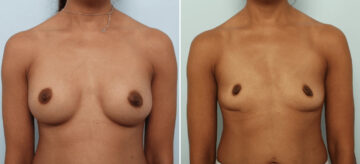Breast Implant Removal before and after photos in Houston, TX, Patient 85691