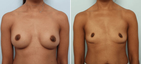Breast Implant Removal Before and After Photos in Houston, TX, Patient 85691