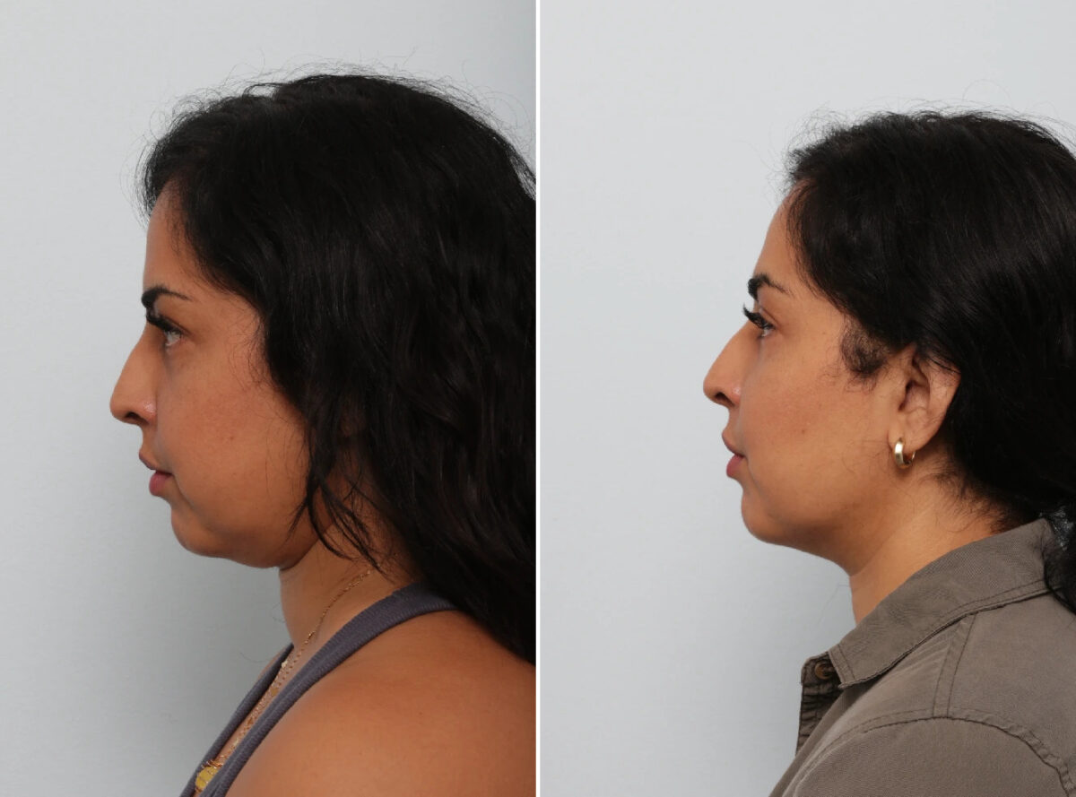 Buccal Fat Pad Removal before and after photos in Houston, TX, Patient 85704