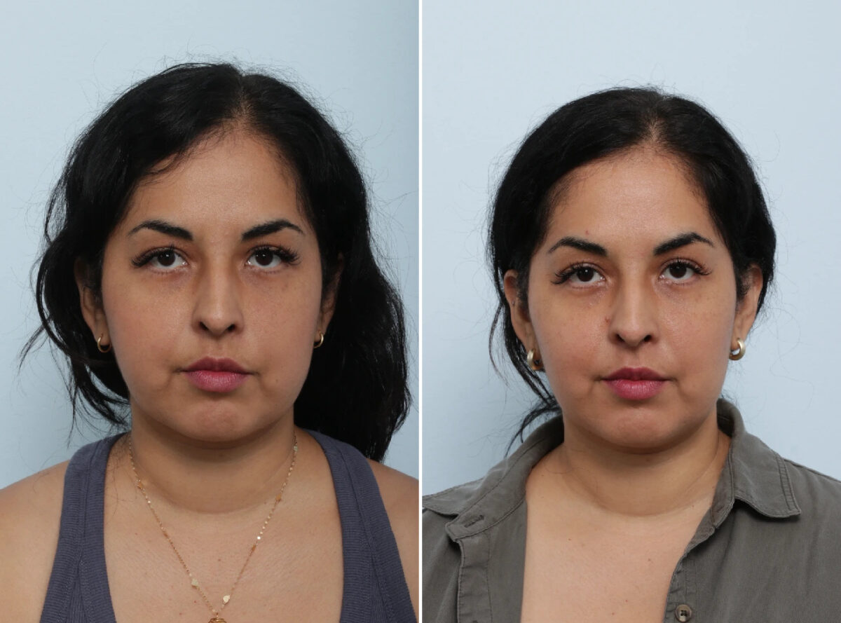 Buccal Fat Pad Removal before and after photos in Houston, TX, Patient 85704