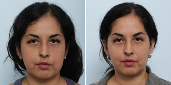 Buccal Fat Pad Removal before and after photos in Houston, TX, Patient 85704