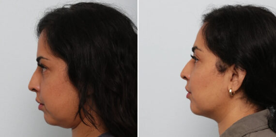 Buccal Fat Pad Removal before and after photos in Houston, TX, Patient 85704