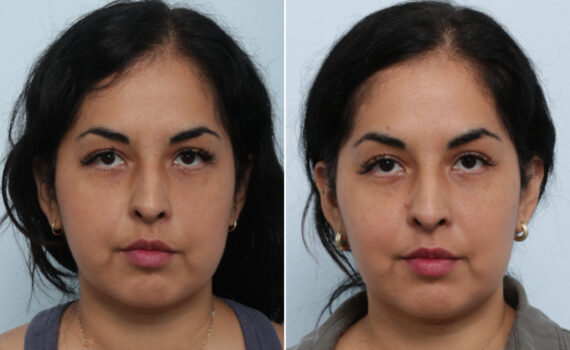 Buccal Fat Pad Removal Before and After Photos in Houston, TX, Patient 85704