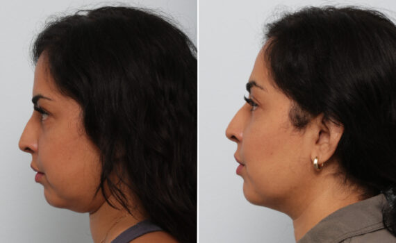 Buccal Fat Pad Removal Before and After Photos in Houston, TX, Patient 85704