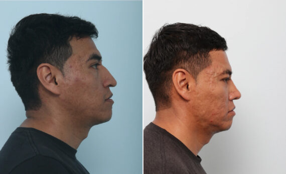 Rhinoplasty before and after photos in Houston, TX, Patient 85721