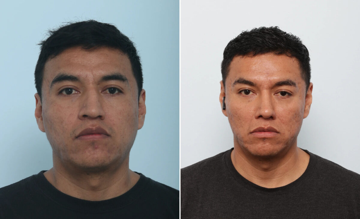 Patient 85721, Rhinoplasty before and after photos Rhinoplasty before and after photos in Houston, TX, Patient 85721