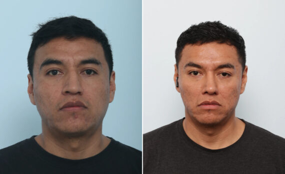 Rhinoplasty before and after photos in Houston, TX, Patient 85721
