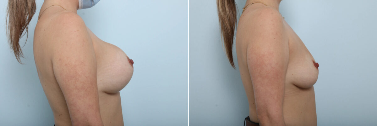Patient 85800, Breast Implant Removal before and after photos Breast Implant Removal before and after photos in Houston, TX, Patient 85800