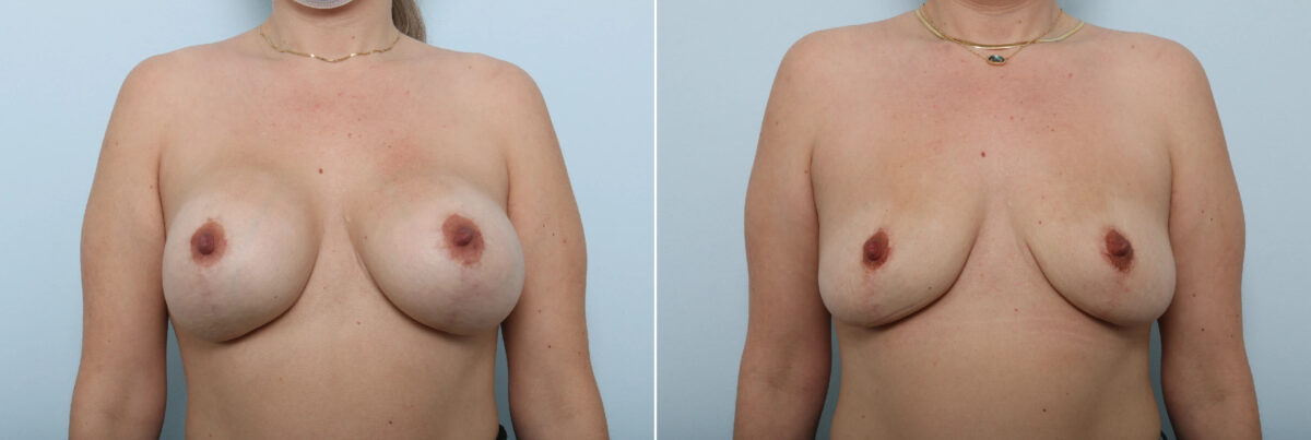 Patient 85800, Breast Implant Removal before and after photos Breast Implant Removal before and after photos in Houston, TX, Patient 85800