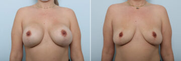 Breast Implant Removal before and after photos in Houston, TX, Patient 85800
