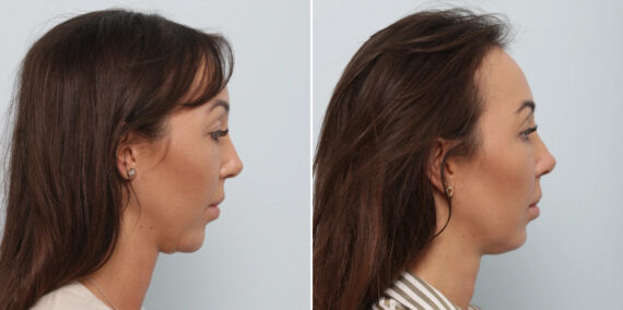 Chin Augmentation before and after photos in Houston, TX, Patient 85829