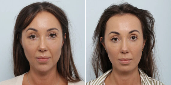 Chin Augmentation before and after photos in Houston, TX, Patient 85829
