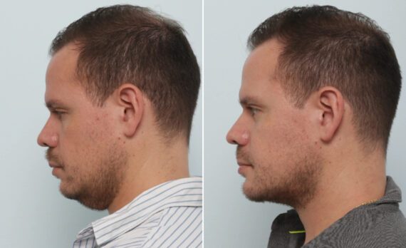 Chin Augmentation before and after photos in Houston, TX, Patient 86045