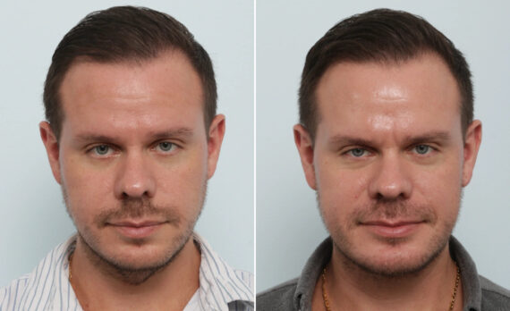 Chin Augmentation before and after photos in Houston, TX, Patient 86045