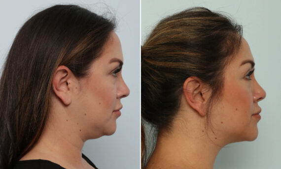 Neck Contouring before and after photos in Houston, TX, Patient 86052