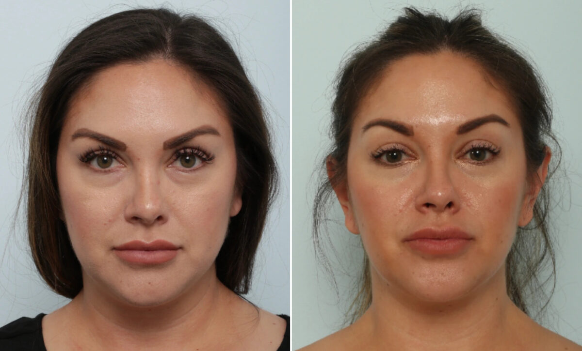 Patient 86052, Neck Contouring before and after photos Neck Contouring before and after photos in Houston, TX, Patient 86052