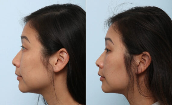 Buccal Fat Pad Removal Before and After Photos in Houston, TX, Patient 86059