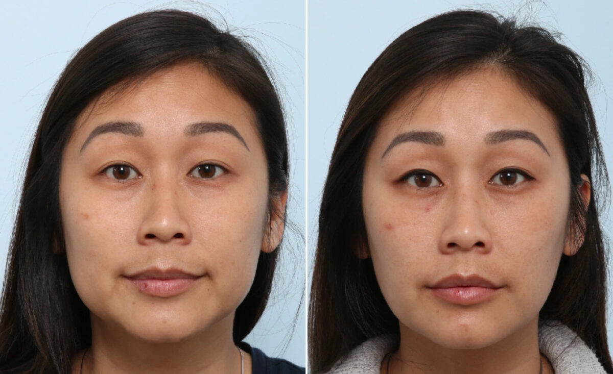 Buccal Fat Pad Removal Before and After Photos in Houston, TX, Patient 86059