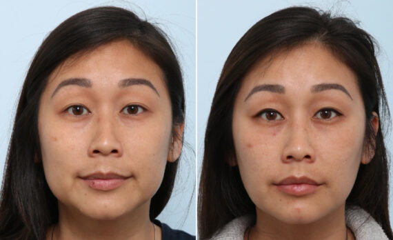 Buccal Fat Pad Removal Before and After Photos in Houston, TX, Patient 86059