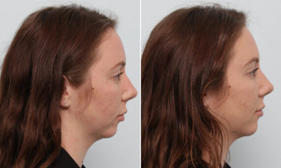 Fillers Before and After Photos in Houston, TX, Patient 86066