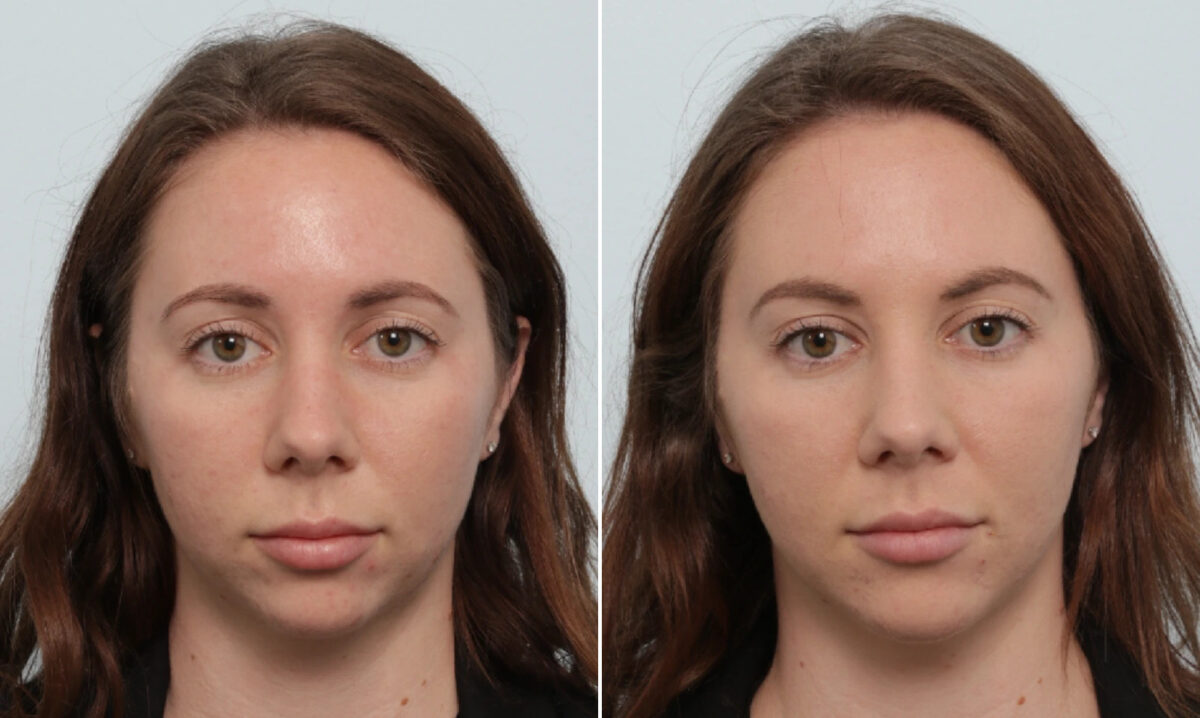 Fillers Before and After Photos in Houston, TX, Patient 86066