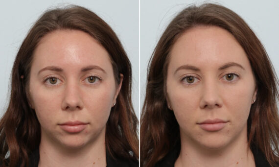 Fillers Before and After Photos in Houston, TX, Patient 86066