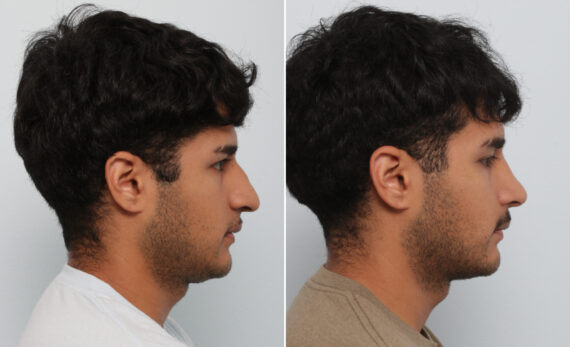 Nose Job / Rhinoplasty Before and After Photos in Houston, TX, Patient 86165