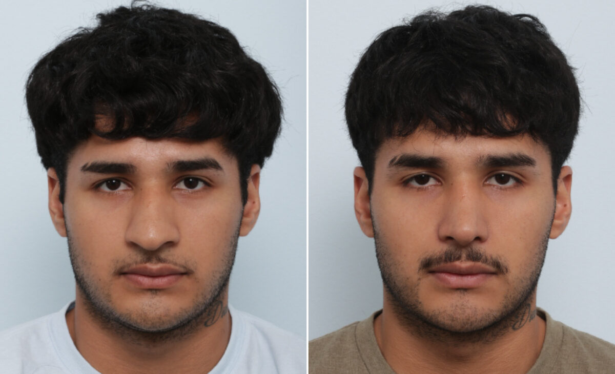 Nose Job / Rhinoplasty Before and After Photos in Houston, TX, Patient 86165
