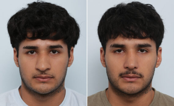 Nose Job / Rhinoplasty Before and After Photos in Houston, TX, Patient 86165