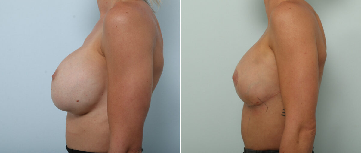 Breast Implant Removal Before and After Photos in Houston, TX, Patient 86172