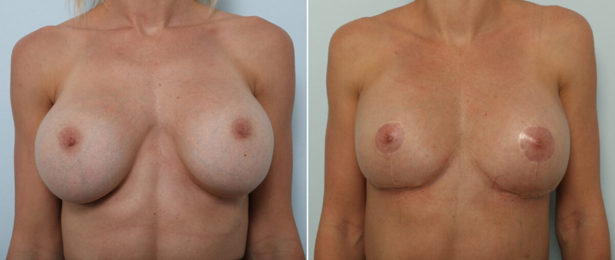 Breast Implant Removal Before and After Photos in Houston, TX, Patient 86172