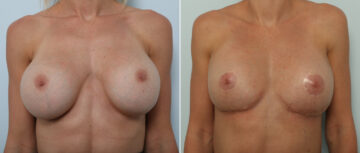 Breast Implant Removal before and after photos in Houston, TX, Patient 86172