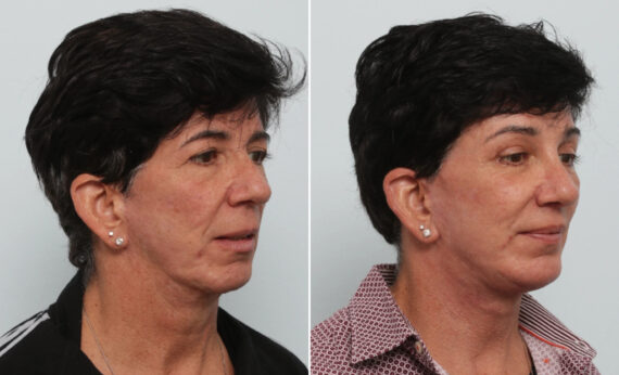 Facelift Before and After Photos in Houston, TX, Patient 86216