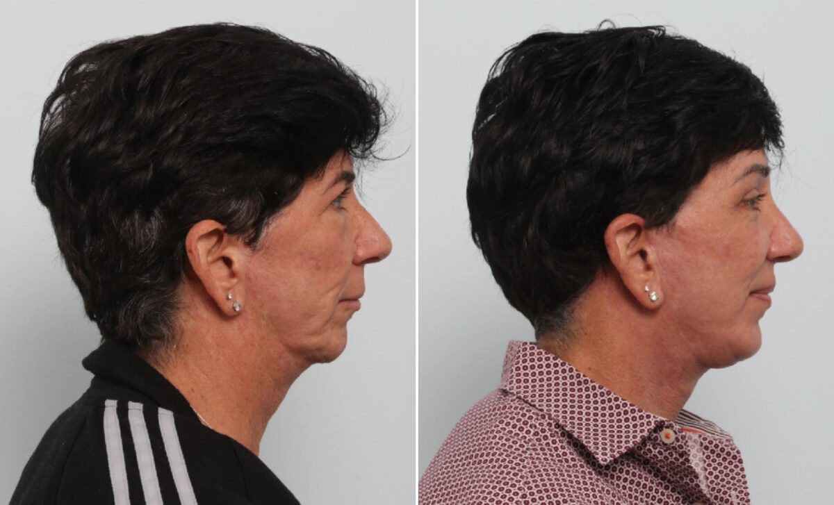 Facelift Before and After Photos in Houston, TX, Patient 86216