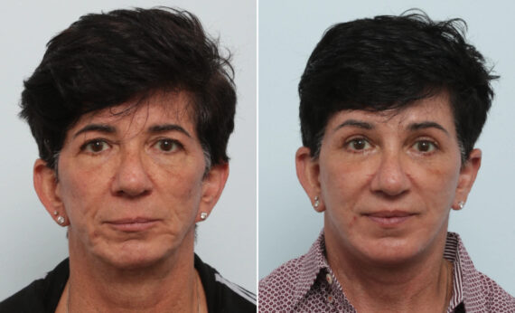 Facelift Before and After Photos in Houston, TX, Patient 86216