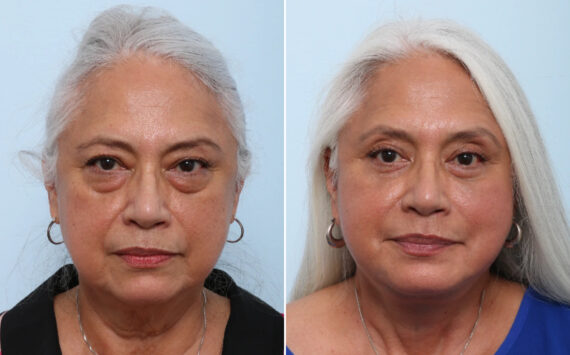 Facelift Before and After Photos in Houston, TX, Patient 86220