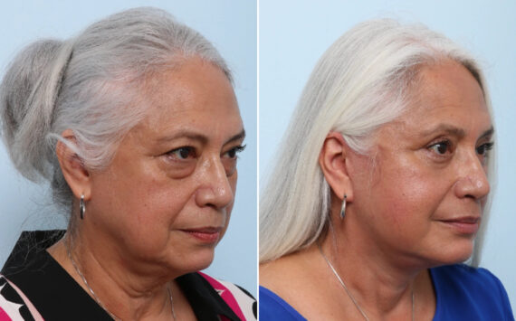 Facelift Before and After Photos in Houston, TX, Patient 86220
