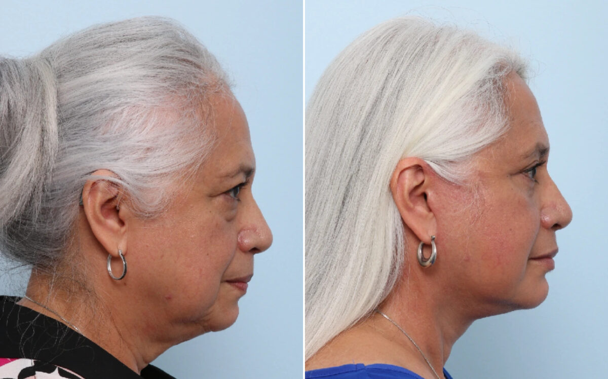 Facelift Before and After Photos in Houston, TX, Patient 86220