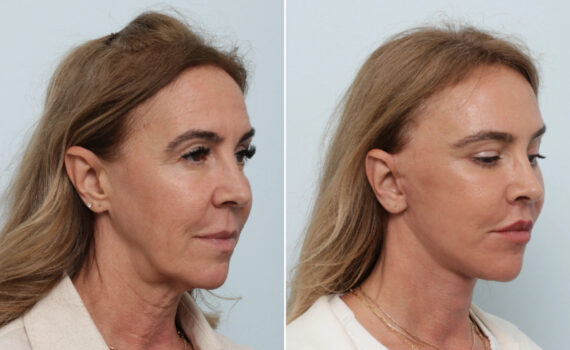 Facelift Before and After Photos in Houston, TX, Patient 86224