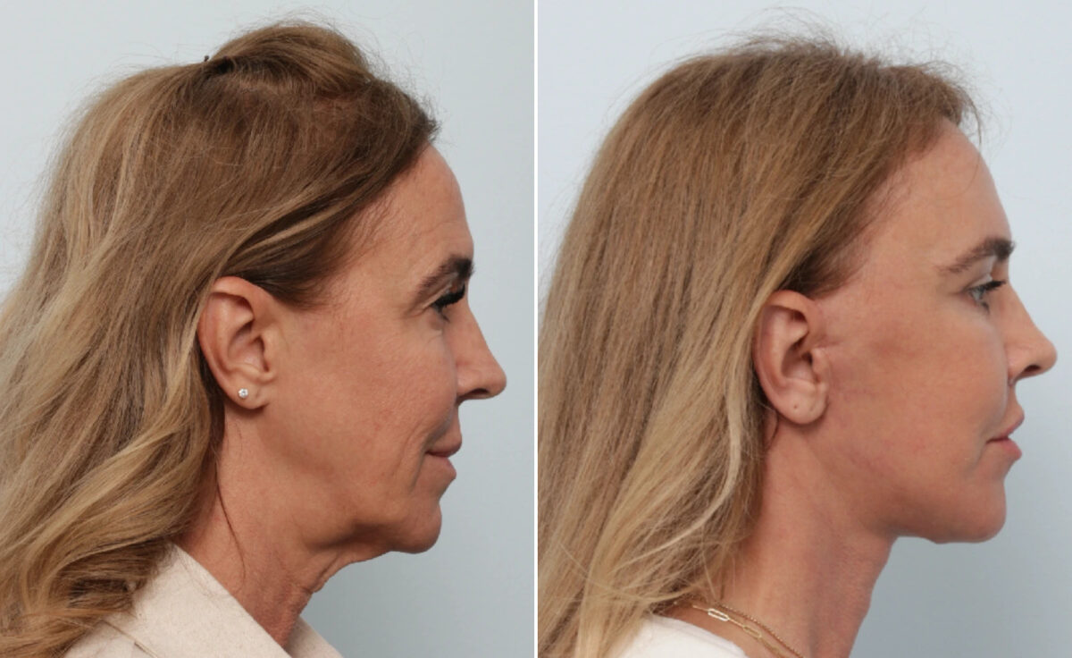 Facelift Before and After Photos in Houston, TX, Patient 86224