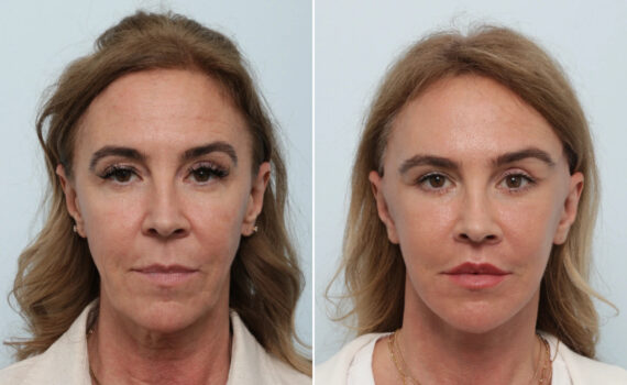 Facelift Before and After Photos in Houston, TX, Patient 86224