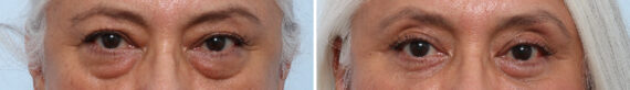Eyelid Surgery / Blepharoplasty Before and After Photos in Houston, TX, Patient 86228