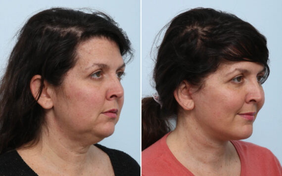 Facelift Before and After Photos in Houston, TX, Patient 86233